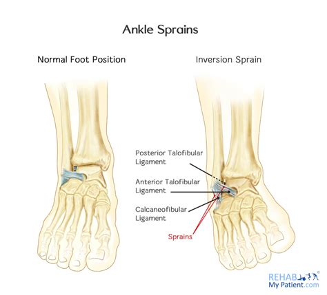 lateral ligament ankle injury